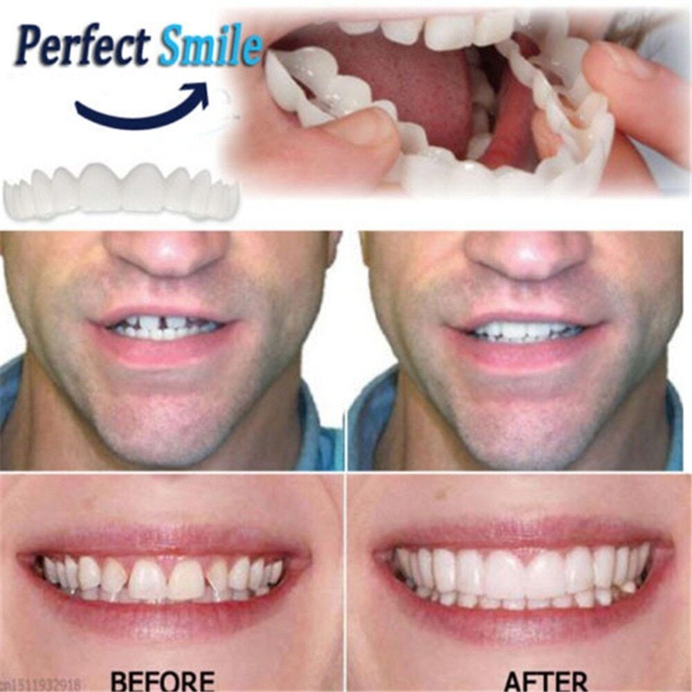 Snap-On Dentures