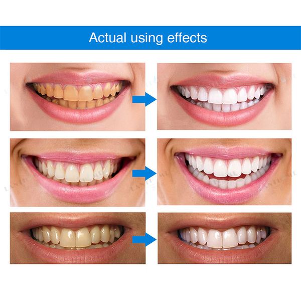 🔥Teeth Whitening Essence