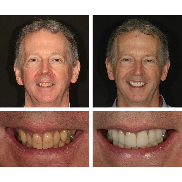 🔥Teeth Whitening Essence