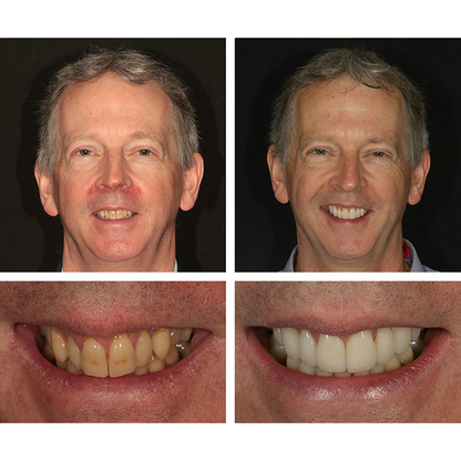 🔥Teeth Whitening Essence