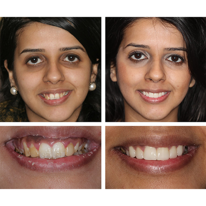 🔥Teeth Whitening Essence