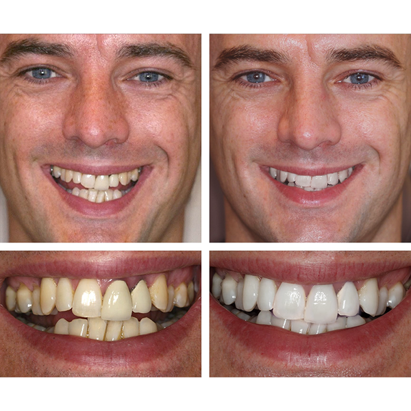 🔥Teeth Whitening Essence